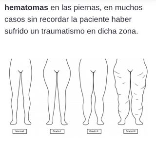 36€.LIPEDEMA, MASAJES TERAPEUTICOS  A DOMICILIO.