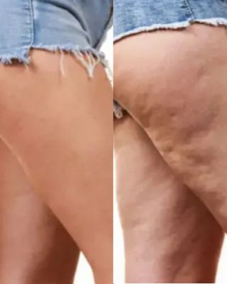 36€.LIPEDEMA, MASAJES TERAPEUTICOS  A DOMICILIO.