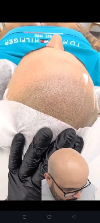 Micropigmentación capilar, barba, cejas..