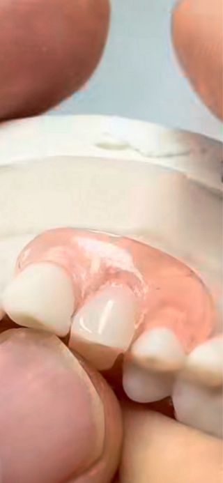 Reparación urgente de protesis dentales