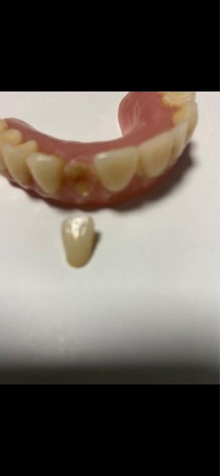 Reparación urgente de protesis dentales