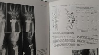 Fracturas del Extremo Distal del Radio