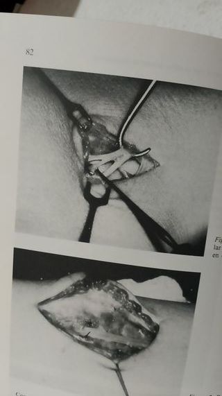 Fracturas del Extremo Distal del Radio