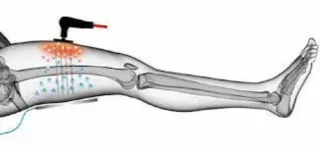 Tecarterapia/diatermina (Indiba) a domicilio