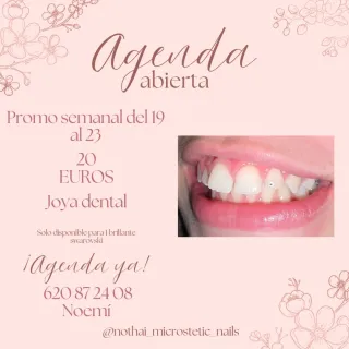 Joya dental o gema dental