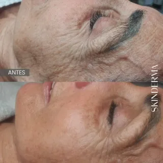 Aparatologia estética avanzada facial