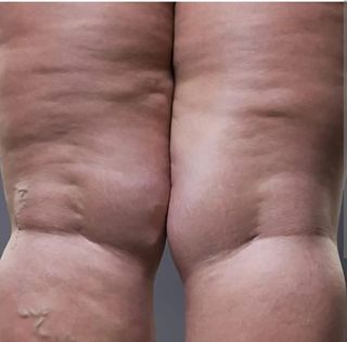 30€ MASAJE TERAPÉUTICO LIPEDEMA, REMODELACIONES.