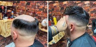 Prótesis Capilar Indetectable Cabello Natural