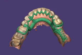 Diseño digital esquelético para prótesis dental.