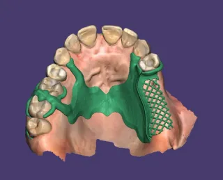 Diseño digital esquelético para prótesis dental.