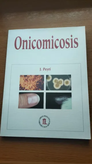 Onicomicosis.
