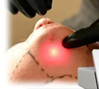 Láser Endolifting 980nm Diode Laser de mesa