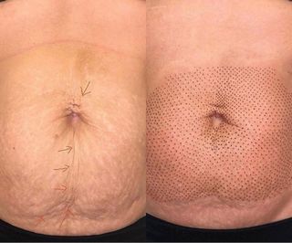 Curso Fibroblast Corporal Estrias y Flacidez