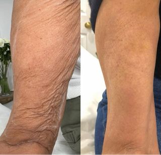 Curso Fibroblast Corporal Estrias y Flacidez