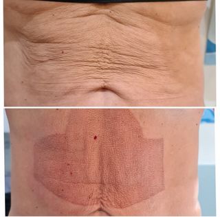 Curso Fibroblast Corporal Estrias y Flacidez