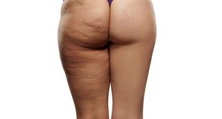 Masaje Post Operatorio, Celulitis, Flacidez