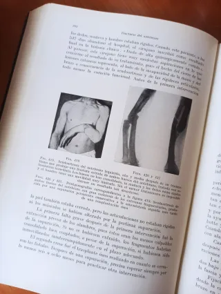 Libro antiguo 1934: Tratamiento de las Fracturas