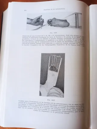 Libro antiguo 1934: Tratamiento de las Fracturas