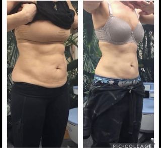 Láser Reductor + formacion protocolo +rentabilidad