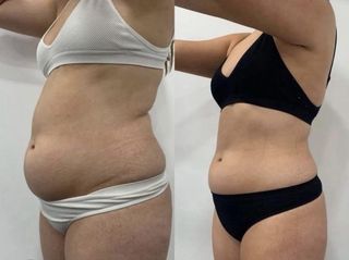 Láser Reductor + formacion protocolo +rentabilidad