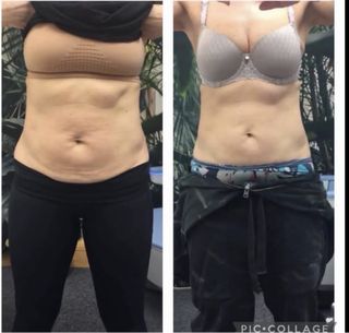 Láser Reductor + formacion protocolo +rentabilidad