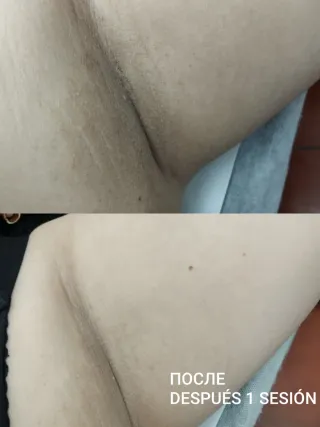 Aclarar zona íntima