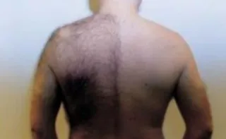 Depilación Masculina