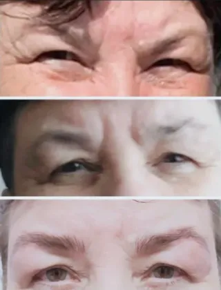 Microblanding. Pelo a pelo