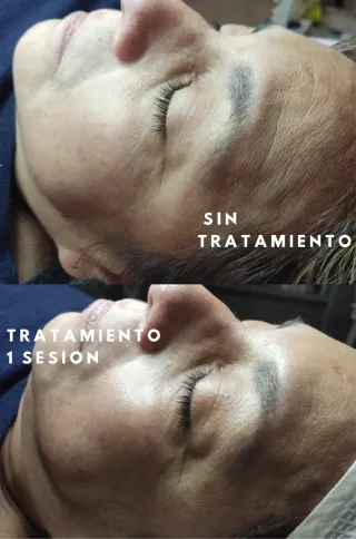 Limpieza facial y diagnóstico en Sant Feliu