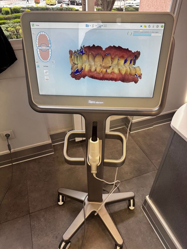 Itero Element 2 Digital Scanner Dental