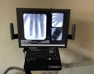 Fluoroscopio Orthoscan HD Digital