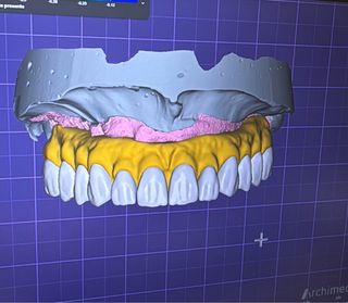 Diseño Digital Prótesis Fijas