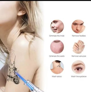 Neatcell Láser Eliminación Tatuajes, Manchas