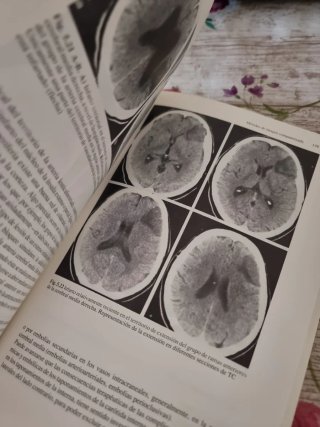Isquemia cerebral