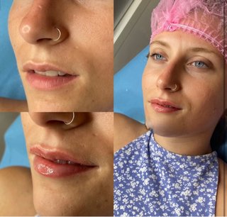 PROMOCION Tratamiento facial ácido hialurónico