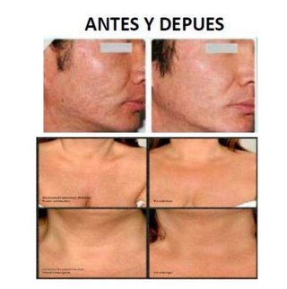 Sesión Dermapen Facial