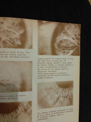 Diagnóstico Por El Iris