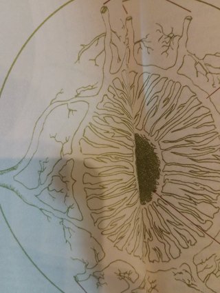 Diagnóstico Por El Iris