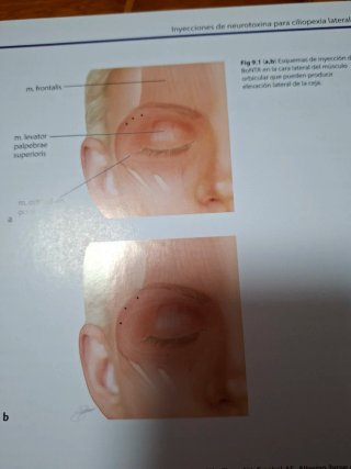 Medicina estetica en tecnicas de inyección