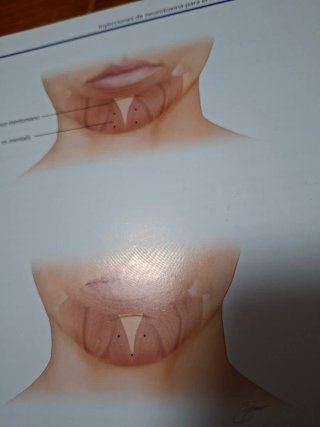 Medicina estetica en tecnicas de inyección