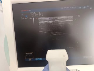 Ultrasonido Médico Esaote MyLab 60