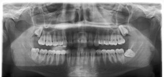 Equipo Dental Panorámico 2D