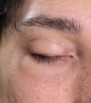 Protesi in silicone occhi