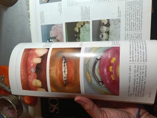 Lore de revistas prótesis dental soproden