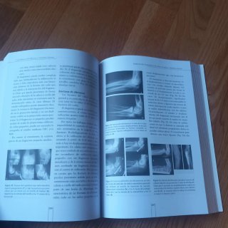 Fracturas infantiles conceptos y principios