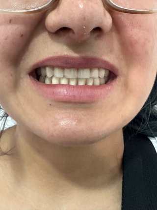 Prótesis dental superior e inferior