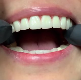 Prótesis dental completa superior