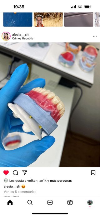 Prótesis dental completa superior