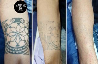 Láser eliminación de tatuajes