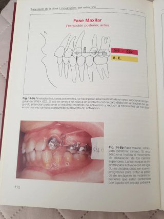 LA TECNICA DEL ANCLAJE INVERSO Y SU ECUACION.